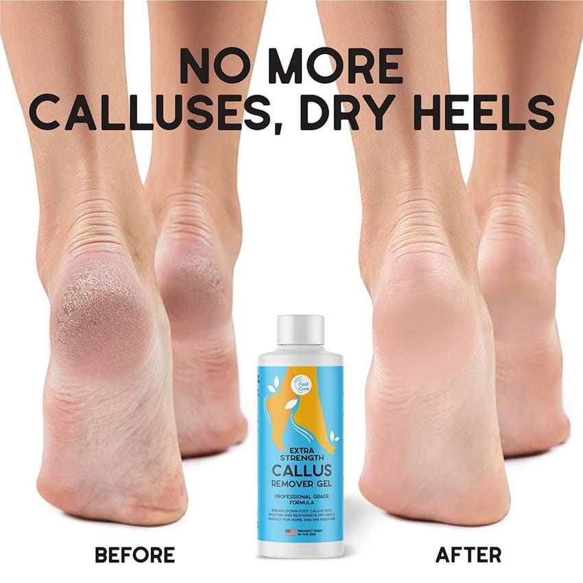 Callus Remover Gel For Feet - Made In USA