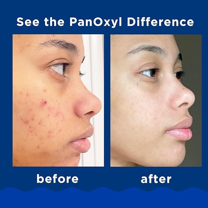 PanOxyl Acne Foaming Wash Benzoyl Peroxide 10 Maximum Strength Antimicrobial 156g product thumbnail 5