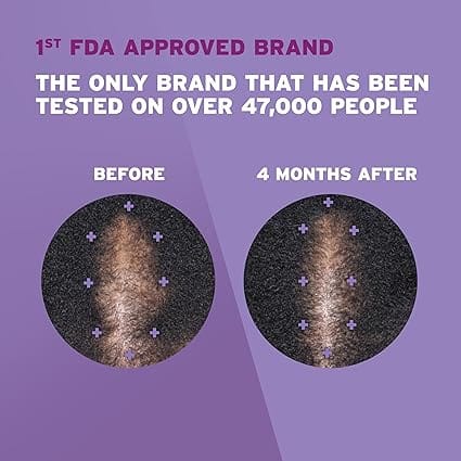 Rogaine for Women 5% Minoxidil Foam – Hair Regrowth Treatment (4-Month Supply) product thumbnail 3